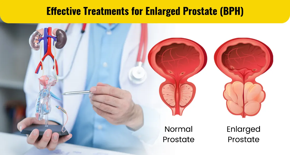 Treatments for Enlarged Prostate