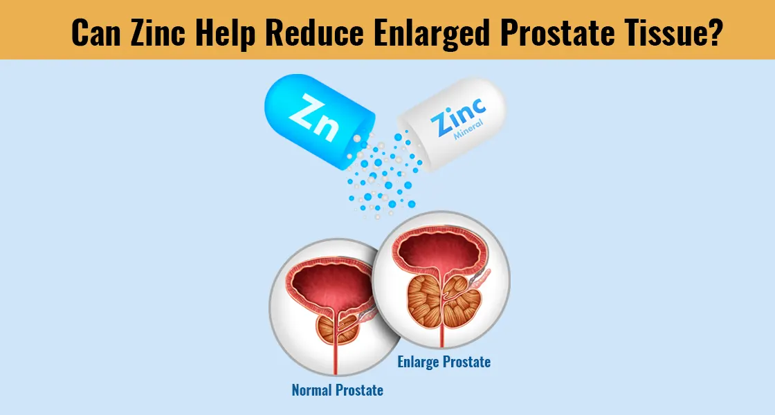 Does Zinc Shrink Prostate Tissue?